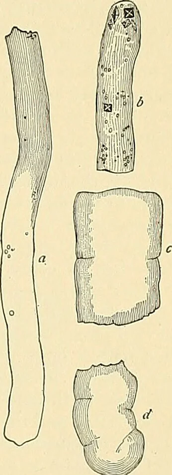 An illustration from An American text-book of genito-urinary diseases, syphilis and diseases of the skin / Ed. by L. Bolton Bangs ... and W. A. Hardaway ... Illustrated with 300 engravings and 20 full-page colored plates., 1898, leaf 47