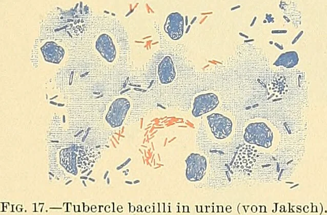 An illustration from An American text-book of genito-urinary diseases, syphilis and diseases of the skin / Ed. by L. Bolton Bangs ... and W. A. Hardaway ... Illustrated with 300 engravings and 20 full-page colored plates., 1898, leaf 49
