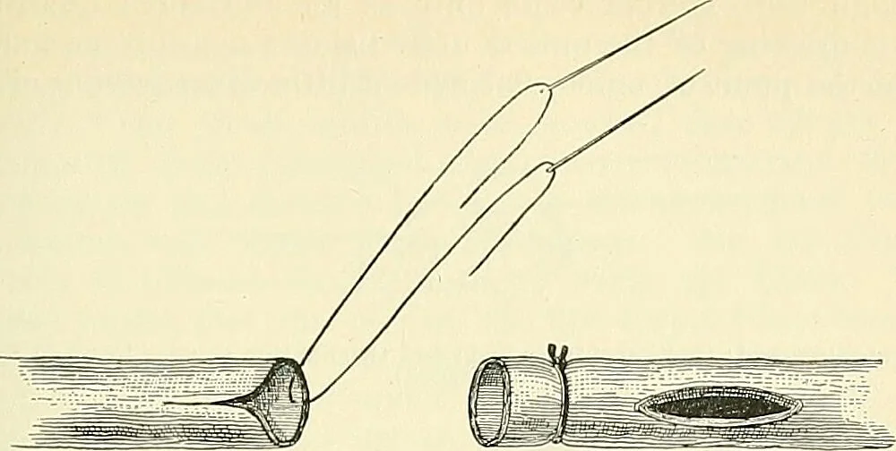An illustration from An American text-book of genito-urinary diseases, syphilis and diseases of the skin / Ed. by L. Bolton Bangs ... and W. A. Hardaway ... Illustrated with 300 engravings and 20 full-page colored plates., 1898, leaf 511