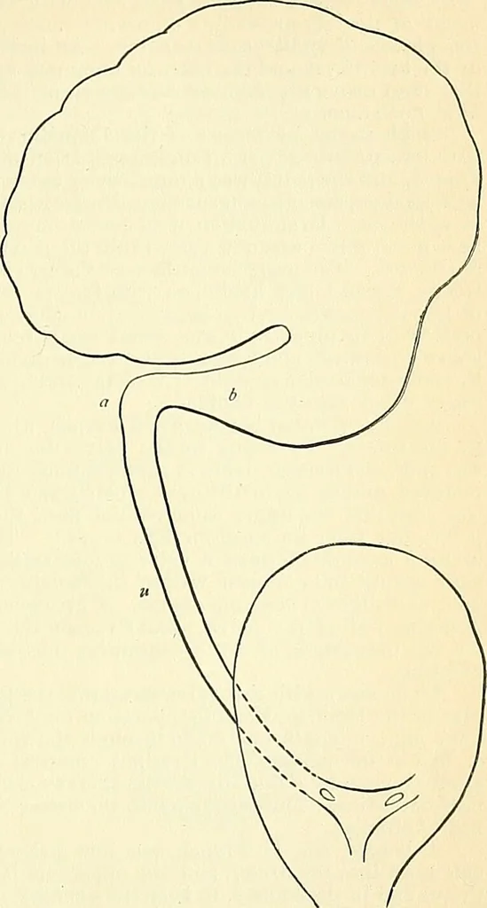 An illustration from An American text-book of genito-urinary diseases, syphilis and diseases of the skin / Ed. by L. Bolton Bangs ... and W. A. Hardaway ... Illustrated with 300 engravings and 20 full-page colored plates., 1898, leaf 523