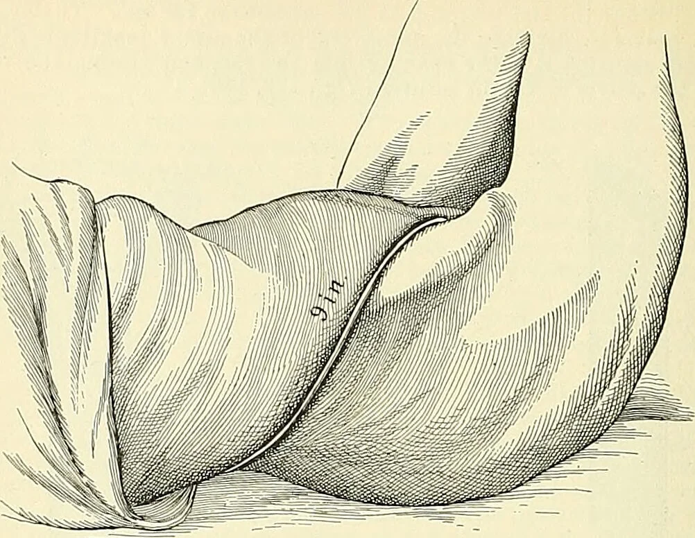 An illustration from An American text-book of genito-urinary diseases, syphilis and diseases of the skin / Ed. by L. Bolton Bangs ... and W. A. Hardaway ... Illustrated with 300 engravings and 20 full-page colored plates., 1898, leaf 532