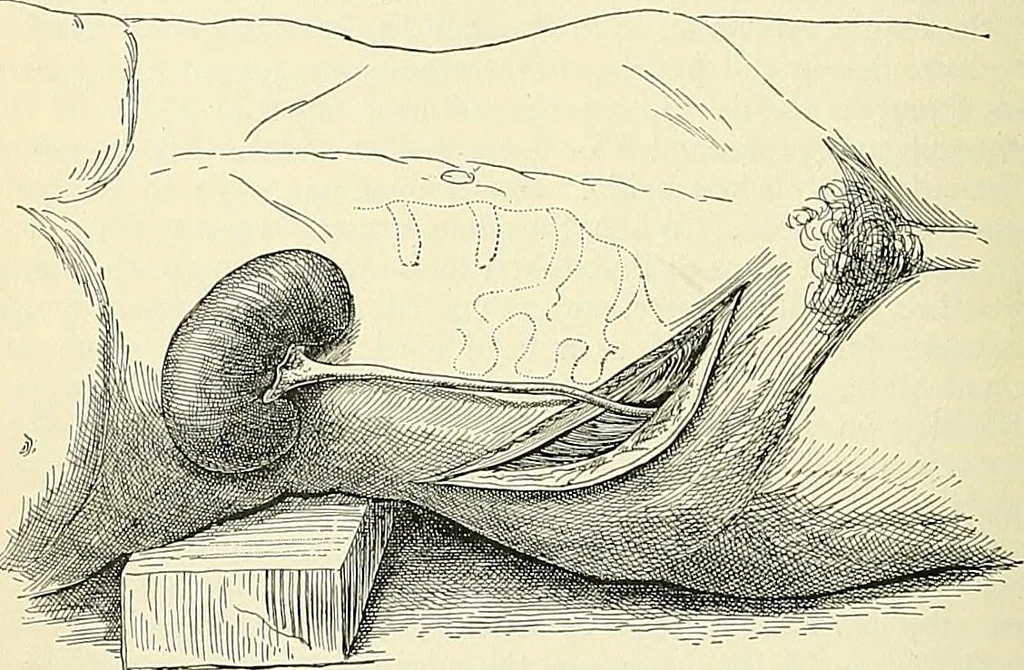 An illustration from An American text-book of genito-urinary diseases, syphilis and diseases of the skin / Ed. by L. Bolton Bangs ... and W. A. Hardaway ... Illustrated with 300 engravings and 20 full-page colored plates., 1898, leaf 548