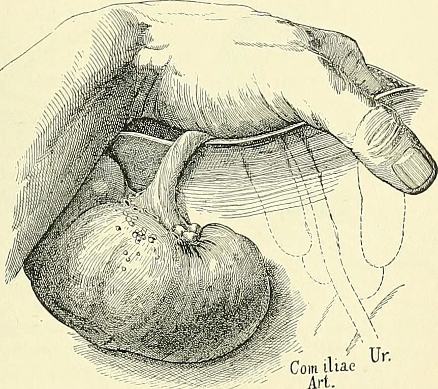 An illustration from An American text-book of genito-urinary diseases, syphilis and diseases of the skin / Ed. by L. Bolton Bangs ... and W. A. Hardaway ... Illustrated with 300 engravings and 20 full-page colored plates., 1898, leaf 549