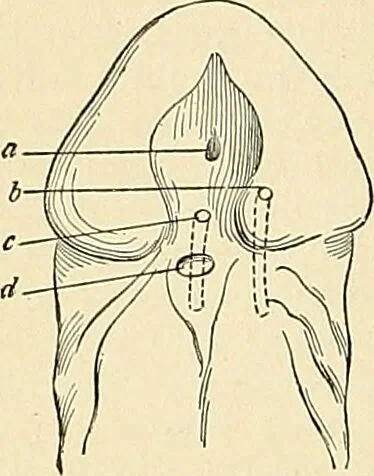 An illustration from An American text-book of genito-urinary diseases, syphilis and diseases of the skin / Ed. by L. Bolton Bangs ... and W. A. Hardaway ... Illustrated with 300 engravings and 20 full-page colored plates., 1898, leaf 56