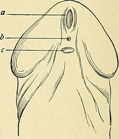 An illustration from An American text-book of genito-urinary diseases, syphilis and diseases of the skin / Ed. by L. Bolton Bangs ... and W. A. Hardaway ... Illustrated with 300 engravings and 20 full-page colored plates., 1898, leaf 56