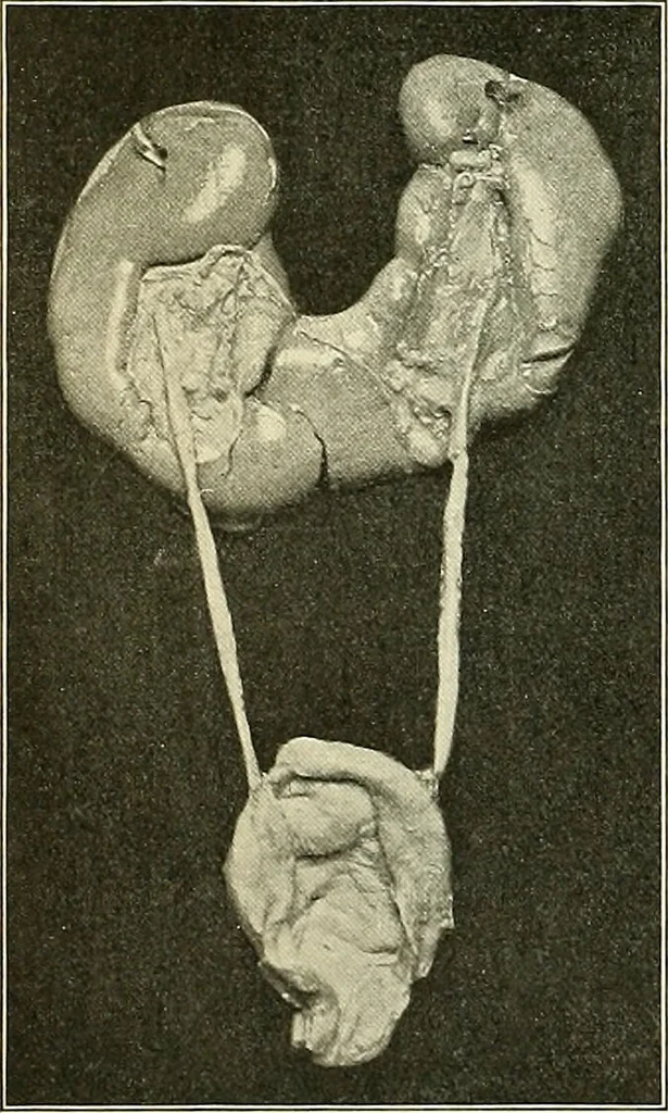 An illustration from An American text-book of genito-urinary diseases, syphilis and diseases of the skin / Ed. by L. Bolton Bangs ... and W. A. Hardaway ... Illustrated with 300 engravings and 20 full-page colored plates., 1898, leaf 564