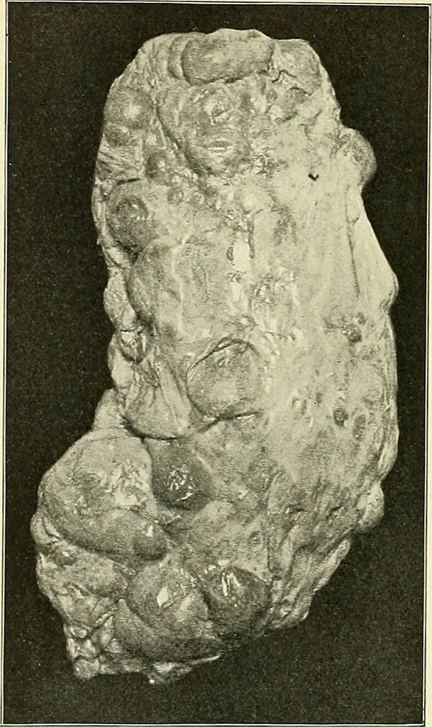 An illustration from An American text-book of genito-urinary diseases, syphilis and diseases of the skin / Ed. by L. Bolton Bangs ... and W. A. Hardaway ... Illustrated with 300 engravings and 20 full-page colored plates., 1898, leaf 566