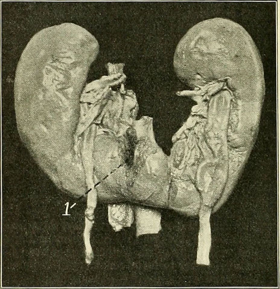 An illustration from An American text-book of genito-urinary diseases, syphilis and diseases of the skin / Ed. by L. Bolton Bangs ... and W. A. Hardaway ... Illustrated with 300 engravings and 20 full-page colored plates., 1898, leaf 568