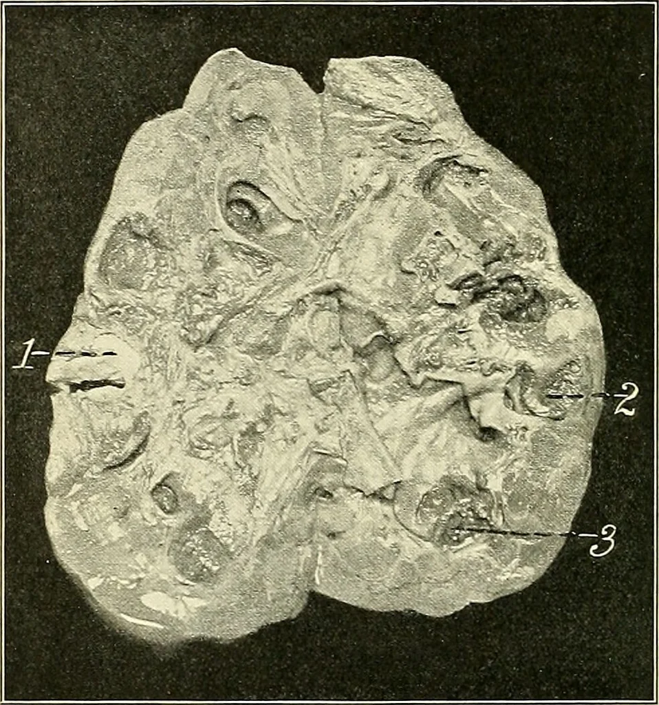 An illustration from An American text-book of genito-urinary diseases, syphilis and diseases of the skin / Ed. by L. Bolton Bangs ... and W. A. Hardaway ... Illustrated with 300 engravings and 20 full-page colored plates., 1898, leaf 578