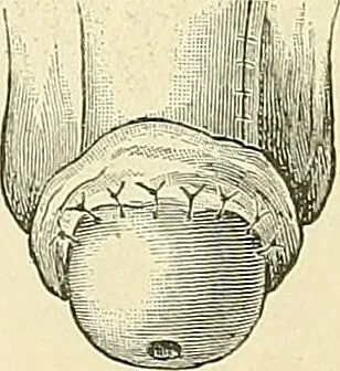 An illustration from An American text-book of genito-urinary diseases, syphilis and diseases of the skin / Ed. by L. Bolton Bangs ... and W. A. Hardaway ... Illustrated with 300 engravings and 20 full-page colored plates., 1898, leaf 58