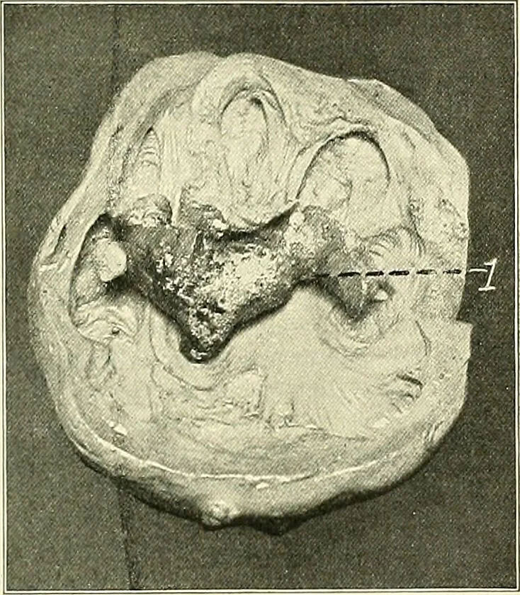 An illustration from An American text-book of genito-urinary diseases, syphilis and diseases of the skin / Ed. by L. Bolton Bangs ... and W. A. Hardaway ... Illustrated with 300 engravings and 20 full-page colored plates., 1898, leaf 581