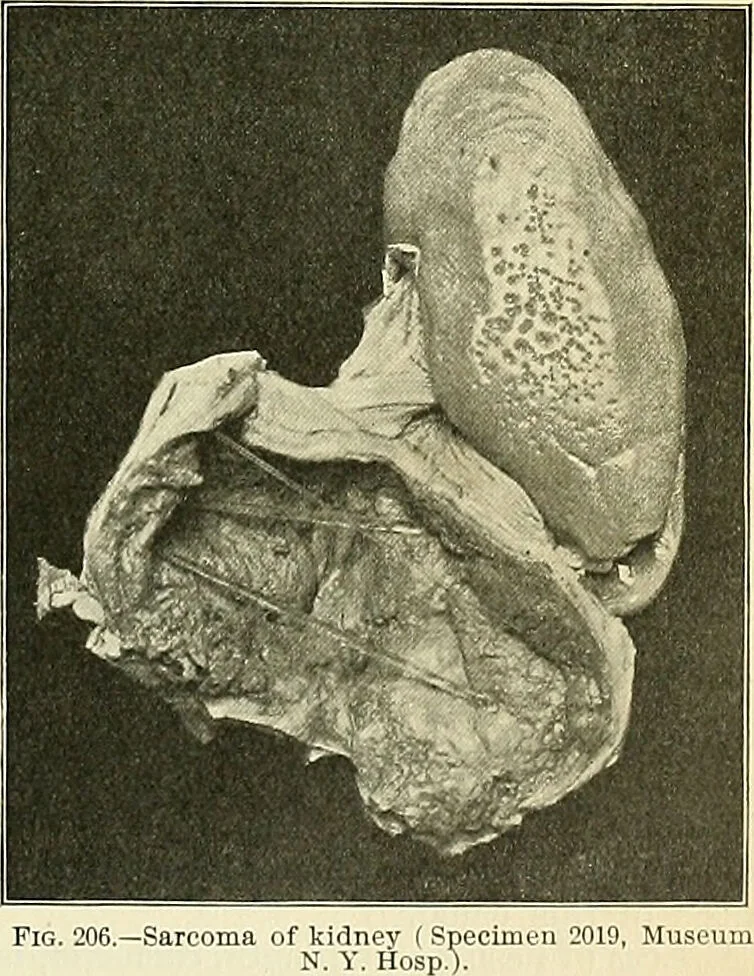 An illustration from An American text-book of genito-urinary diseases, syphilis and diseases of the skin / Ed. by L. Bolton Bangs ... and W. A. Hardaway ... Illustrated with 300 engravings and 20 full-page colored plates., 1898, leaf 595