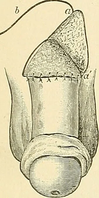 An illustration from An American text-book of genito-urinary diseases, syphilis and diseases of the skin / Ed. by L. Bolton Bangs ... and W. A. Hardaway ... Illustrated with 300 engravings and 20 full-page colored plates., 1898, leaf 60