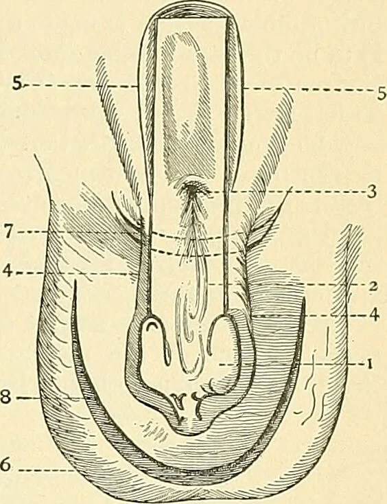 An illustration from An American text-book of genito-urinary diseases, syphilis and diseases of the skin / Ed. by L. Bolton Bangs ... and W. A. Hardaway ... Illustrated with 300 engravings and 20 full-page colored plates., 1898, leaf 61
