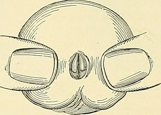 An illustration from An American text-book of genito-urinary diseases, syphilis and diseases of the skin / Ed. by L. Bolton Bangs ... and W. A. Hardaway ... Illustrated with 300 engravings and 20 full-page colored plates., 1898, leaf 62