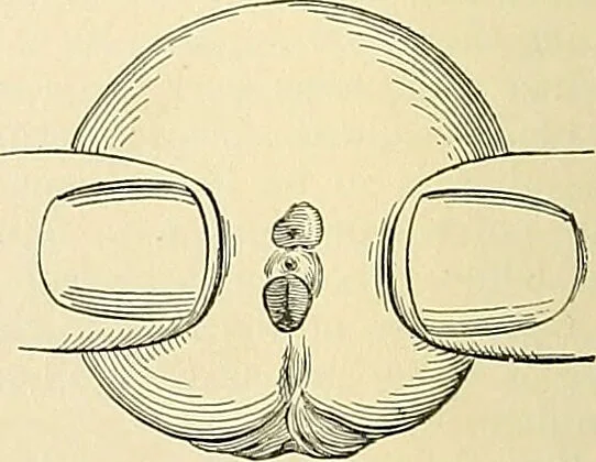 An illustration from An American text-book of genito-urinary diseases, syphilis and diseases of the skin / Ed. by L. Bolton Bangs ... and W. A. Hardaway ... Illustrated with 300 engravings and 20 full-page colored plates., 1898, leaf 62