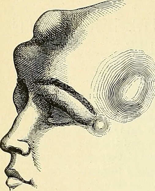 An illustration from An American text-book of genito-urinary diseases, syphilis and diseases of the skin / Ed. by L. Bolton Bangs ... and W. A. Hardaway ... Illustrated with 300 engravings and 20 full-page colored plates., 1898, leaf 680