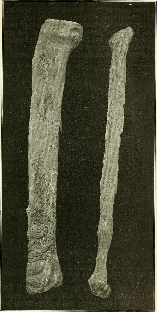 An illustration from An American text-book of genito-urinary diseases, syphilis and diseases of the skin / Ed. by L. Bolton Bangs ... and W. A. Hardaway ... Illustrated with 300 engravings and 20 full-page colored plates., 1898, leaf 681