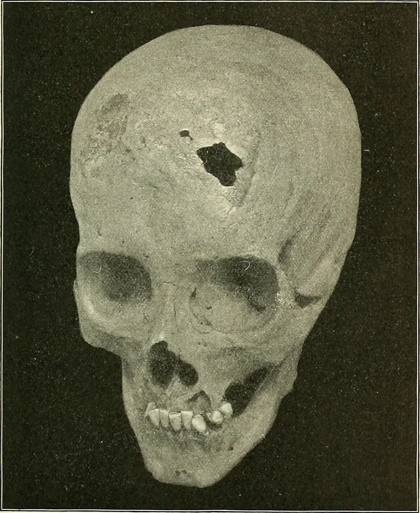 An illustration from An American text-book of genito-urinary diseases, syphilis and diseases of the skin / Ed. by L. Bolton Bangs ... and W. A. Hardaway ... Illustrated with 300 engravings and 20 full-page colored plates., 1898, leaf 683