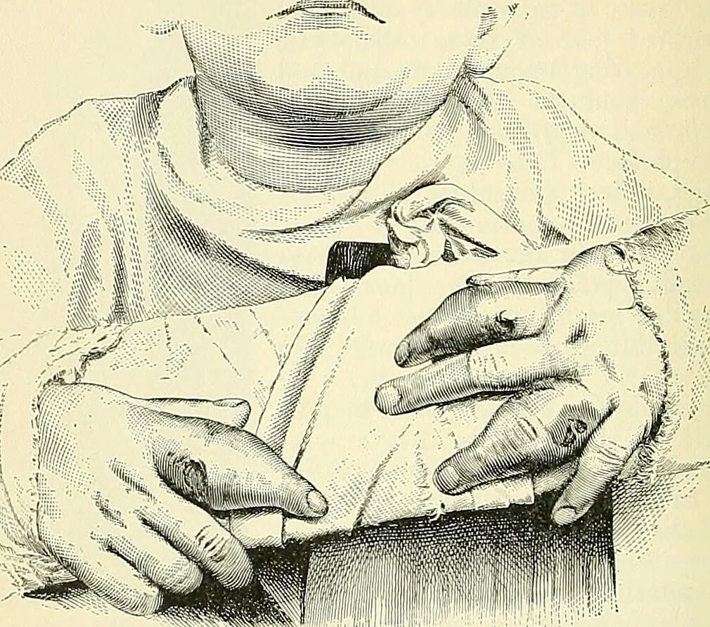An illustration from An American text-book of genito-urinary diseases, syphilis and diseases of the skin / Ed. by L. Bolton Bangs ... and W. A. Hardaway ... Illustrated with 300 engravings and 20 full-page colored plates., 1898, leaf 688