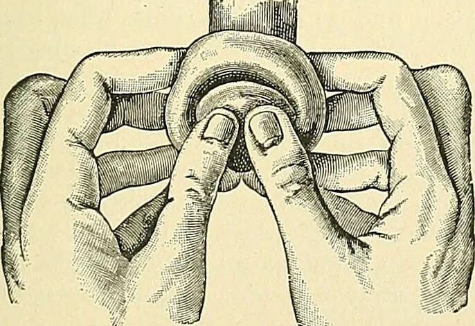 An illustration from An American text-book of genito-urinary diseases, syphilis and diseases of the skin / Ed. by L. Bolton Bangs ... and W. A. Hardaway ... Illustrated with 300 engravings and 20 full-page colored plates., 1898, leaf 69