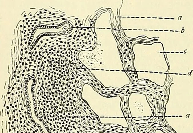 An illustration from An American text-book of genito-urinary diseases, syphilis and diseases of the skin / Ed. by L. Bolton Bangs ... and W. A. Hardaway ... Illustrated with 300 engravings and 20 full-page colored plates., 1898, leaf 706