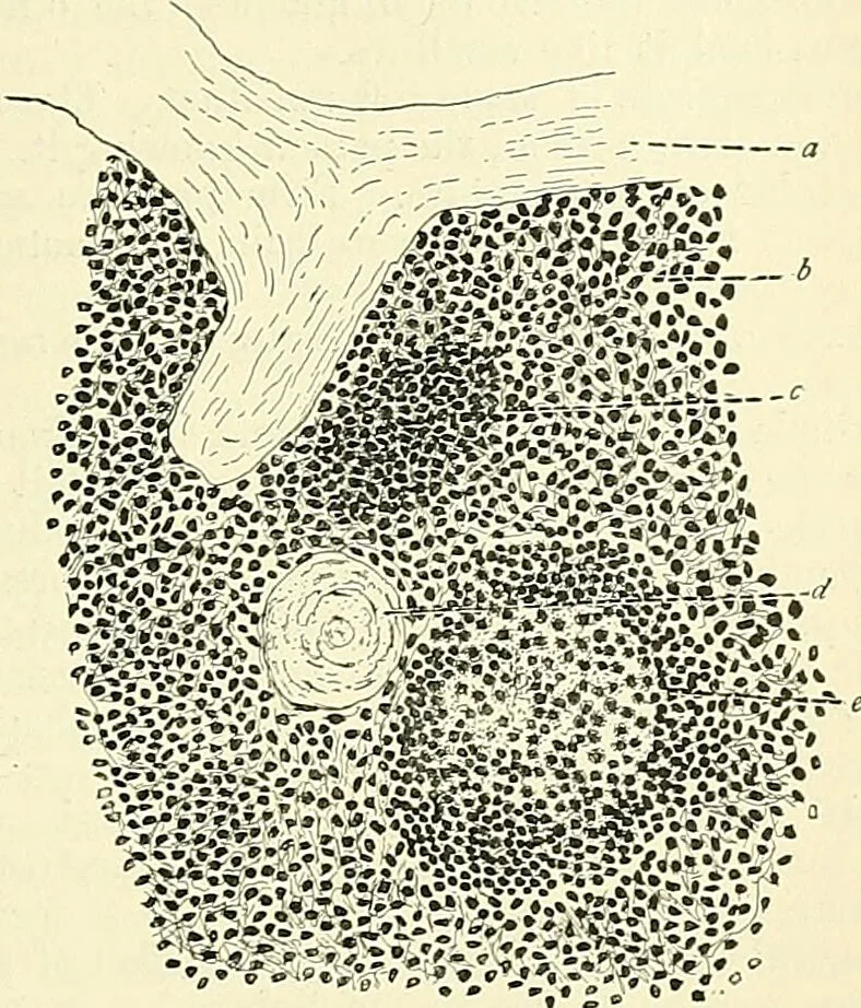 An illustration from An American text-book of genito-urinary diseases, syphilis and diseases of the skin / Ed. by L. Bolton Bangs ... and W. A. Hardaway ... Illustrated with 300 engravings and 20 full-page colored plates., 1898, leaf 709