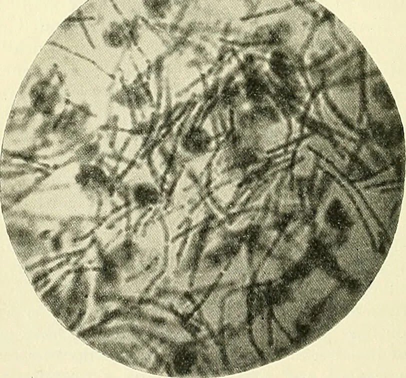 An illustration from An American text-book of genito-urinary diseases, syphilis and diseases of the skin / Ed. by L. Bolton Bangs ... and W. A. Hardaway ... Illustrated with 300 engravings and 20 full-page colored plates., 1898, leaf 848