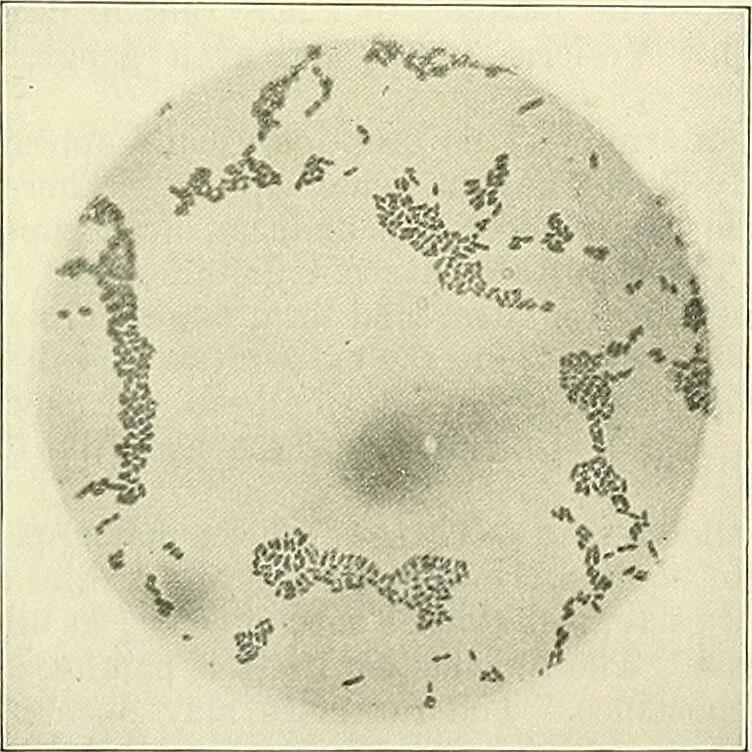 An illustration from An American text-book of genito-urinary diseases, syphilis and diseases of the skin / Ed. by L. Bolton Bangs ... and W. A. Hardaway ... Illustrated with 300 engravings and 20 full-page colored plates., 1898, leaf 851