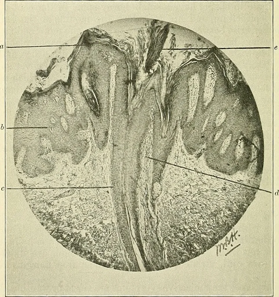 An illustration from An American text-book of genito-urinary diseases, syphilis and diseases of the skin / Ed. by L. Bolton Bangs ... and W. A. Hardaway ... Illustrated with 300 engravings and 20 full-page colored plates., 1898, leaf 954