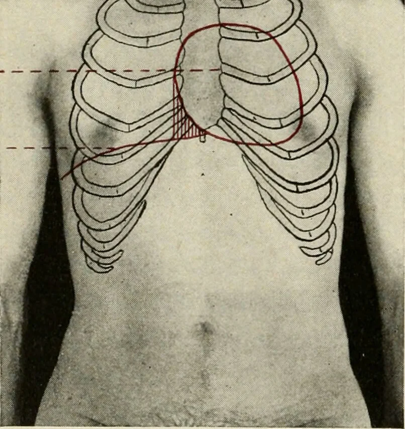An illustration from Diseases of the heart and arterial system : designed to be a practical presentation of the subject for the use of students and practitioners of medicine / by Robert H. Babcock ... with three coloured plates and one hundred and thirty-nine illustrations., 1903, leaf 110