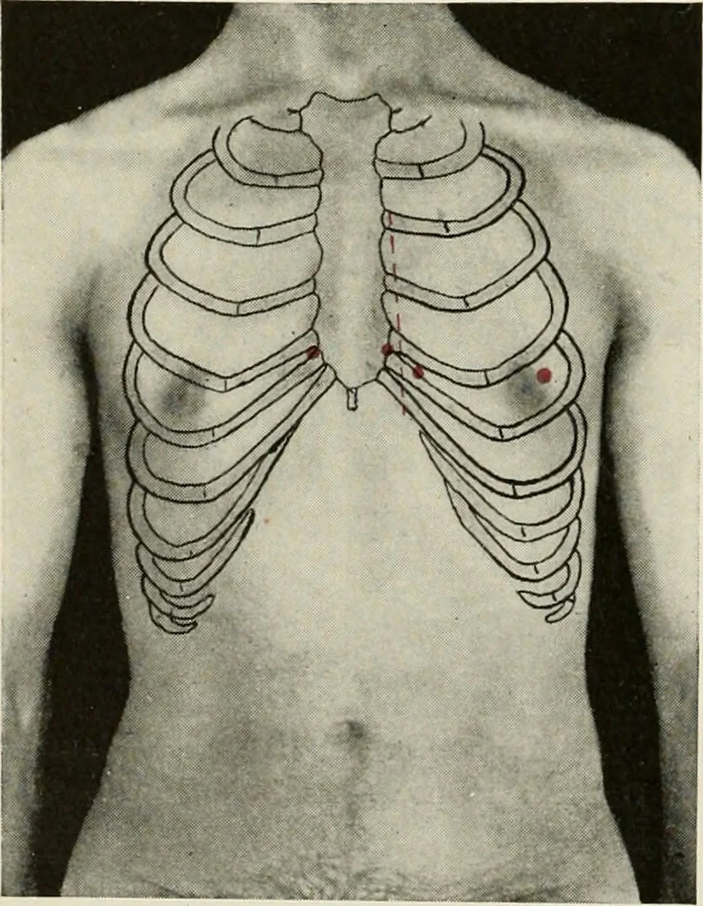An illustration from Diseases of the heart and arterial system : designed to be a practical presentation of the subject for the use of students and practitioners of medicine / by Robert H. Babcock ... with three coloured plates and one hundred and thirty-nine illustrations., 1903, leaf 126