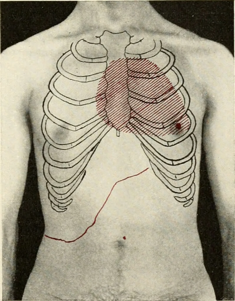 An illustration from Diseases of the heart and arterial system : designed to be a practical presentation of the subject for the use of students and practitioners of medicine / by Robert H. Babcock ... with three coloured plates and one hundred and thirty-nine illustrations., 1903, leaf 147