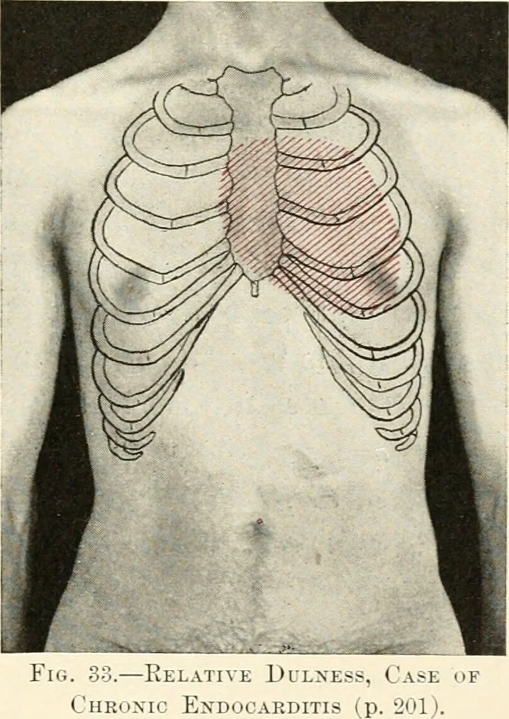 An illustration from Diseases of the heart and arterial system : designed to be a practical presentation of the subject for the use of students and practitioners of medicine / by Robert H. Babcock ... with three coloured plates and one hundred and thirty-nine illustrations., 1903, leaf 235