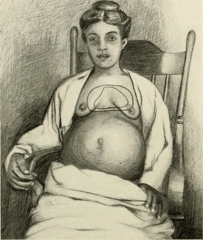 An illustration from Diseases of the heart and arterial system : designed to be a practical presentation of the subject for the use of students and practitioners of medicine / by Robert H. Babcock ... with three coloured plates and one hundred and thirty-nine illustrations., 1903, leaf 290