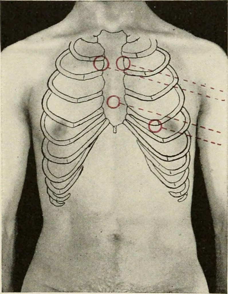 An illustration from Diseases of the heart and arterial system : designed to be a practical presentation of the subject for the use of students and practitioners of medicine / by Robert H. Babcock ... with three coloured plates and one hundred and thirty-nine illustrations., 1903, leaf 36