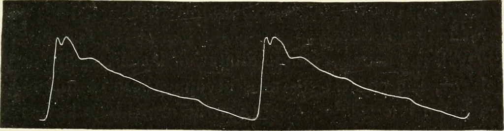 An illustration from Diseases of the heart and arterial system : designed to be a practical presentation of the subject for the use of students and practitioners of medicine / by Robert H. Babcock ... with three coloured plates and one hundred and thirty-nine illustrations., 1903, leaf 363