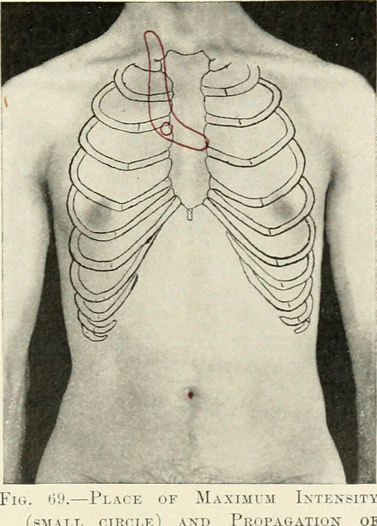 An illustration from Diseases of the heart and arterial system : designed to be a practical presentation of the subject for the use of students and practitioners of medicine / by Robert H. Babcock ... with three coloured plates and one hundred and thirty-nine illustrations., 1903, leaf 371