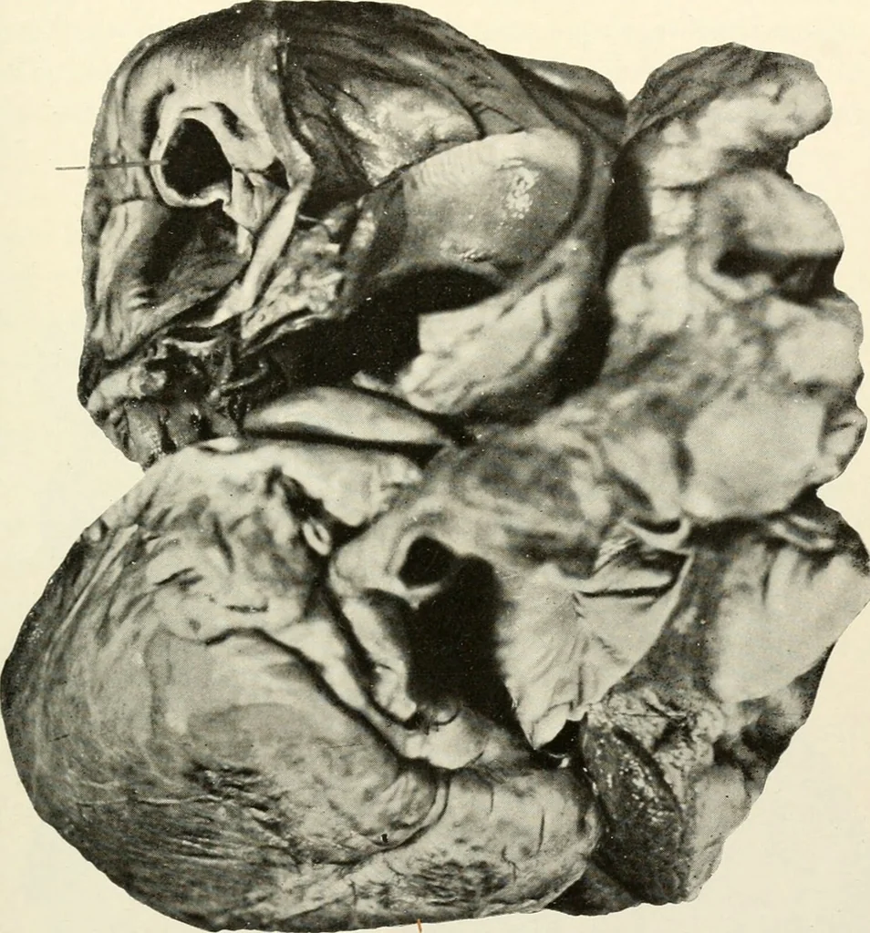 An illustration from Diseases of the heart and arterial system : designed to be a practical presentation of the subject for the use of students and practitioners of medicine / by Robert H. Babcock ... with three coloured plates and one hundred and thirty-nine illustrations., 1903, leaf 417