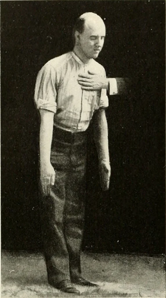 An illustration from Diseases of the heart and arterial system : designed to be a practical presentation of the subject for the use of students and practitioners of medicine / by Robert H. Babcock ... with three coloured plates and one hundred and thirty-nine illustrations., 1903, leaf 494