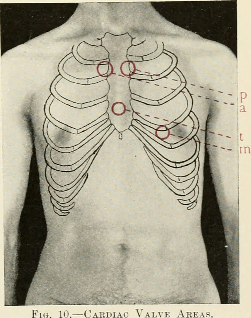 An illustration from Diseases of the heart and arterial system : designed to be a practical presentation of the subject for the use of students and practitioners of medicine / by Robert H. Babcock ... with three coloured plates and one hundred and thirty-nine illustrations., 1903, leaf 57