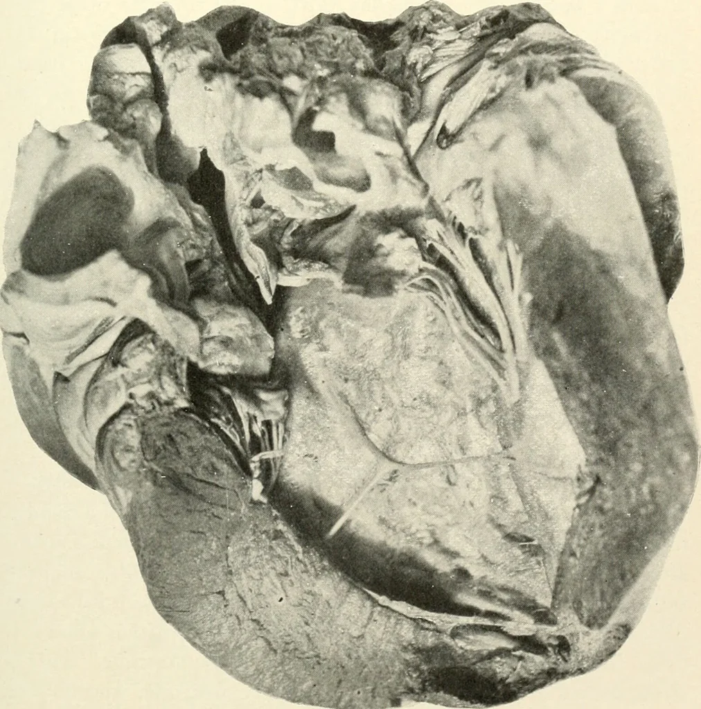 An illustration from Diseases of the heart and arterial system : designed to be a practical presentation of the subject for the use of students and practitioners of medicine / by Robert H. Babcock ... with three coloured plates and one hundred and thirty-nine illustrations., 1903, leaf 65