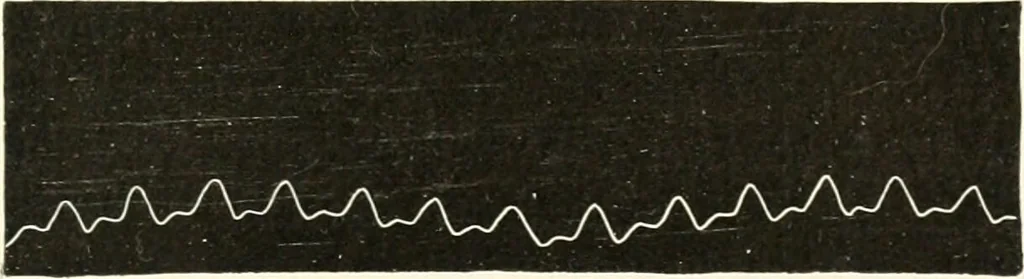 An illustration from Diseases of the heart and arterial system : designed to be a practical presentation of the subject for the use of students and practitioners of medicine / by Robert H. Babcock ... with three coloured plates and one hundred and thirty-nine illustrations., 1903, leaf 769