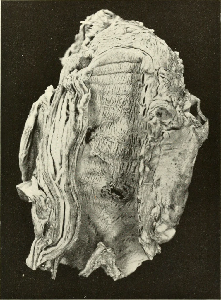 An illustration from Diseases of the heart and arterial system : designed to be a practical presentation of the subject for the use of students and practitioners of medicine / by Robert H. Babcock ... with three coloured plates and one hundred and thirty-nine illustrations., 1903, leaf 833