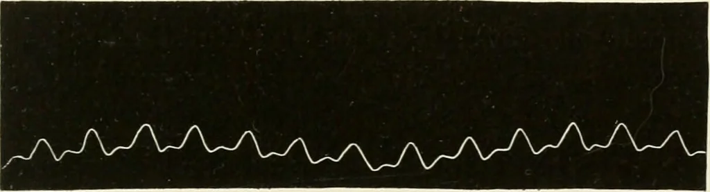 An illustration from Diseases of the heart and arterial system : designed to be a practical presentation of the subject for the use of students and practitioners of medicine / by Robert H. Babcock ... with three coloured plates and one hundred and thirty-nine illustrations., 1903, leaf 855