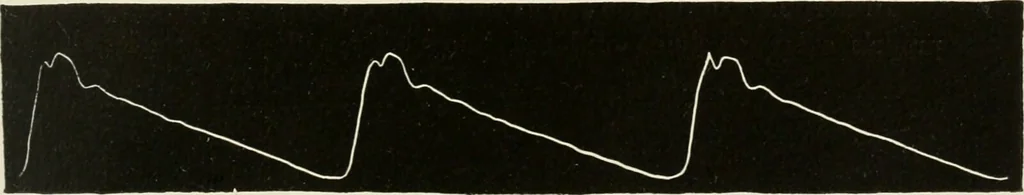 An illustration from Diseases of the heart and arterial system : designed to be a practical presentation of the subject for the use of students and practitioners of medicine / by Robert H. Babcock ... with three coloured plates and one hundred and thirty-nine illustrations., 1903, leaf 855