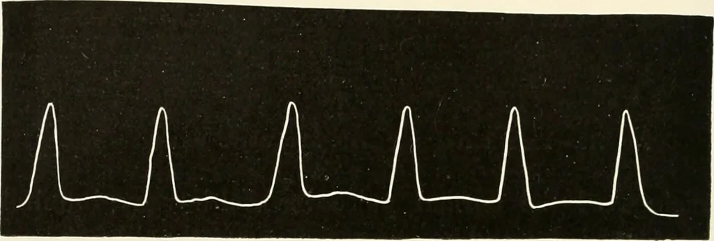 An illustration from Diseases of the heart and arterial system : designed to be a practical presentation of the subject for the use of students and practitioners of medicine / by Robert H. Babcock ... with three coloured plates and one hundred and thirty-nine illustrations., 1903, leaf 856