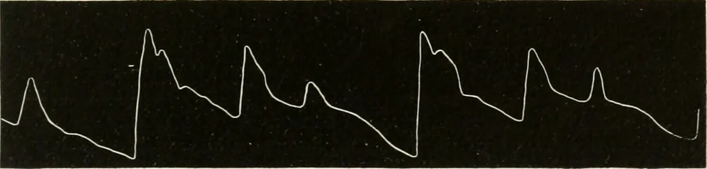 An illustration from Diseases of the heart and arterial system : designed to be a practical presentation of the subject for the use of students and practitioners of medicine / by Robert H. Babcock ... with three coloured plates and one hundred and thirty-nine illustrations., 1903, leaf 859