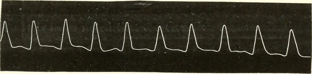 An illustration from Diseases of the heart and arterial system : designed to be a practical presentation of the subject for the use of students and practitioners of medicine / by Robert H. Babcock ... with three coloured plates and one hundred and thirty-nine illustrations., 1903, leaf 861