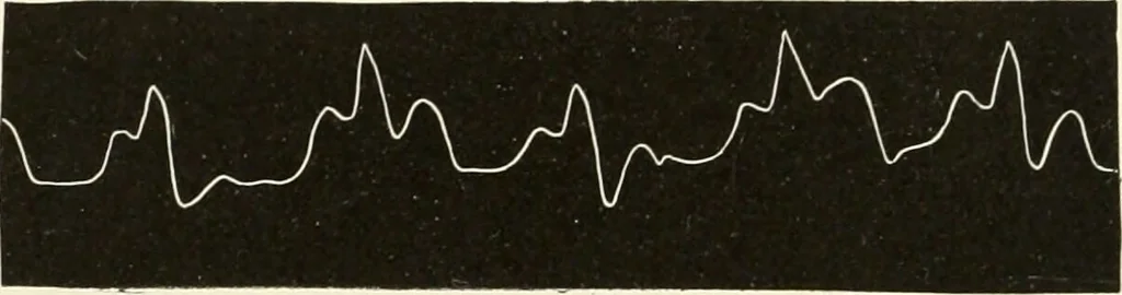 An illustration from Diseases of the heart and arterial system : designed to be a practical presentation of the subject for the use of students and practitioners of medicine / by Robert H. Babcock ... with three coloured plates and one hundred and thirty-nine illustrations., 1903, leaf 862